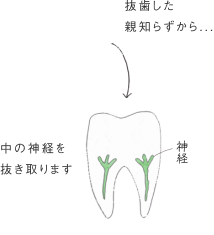中の神経を抜き取ります