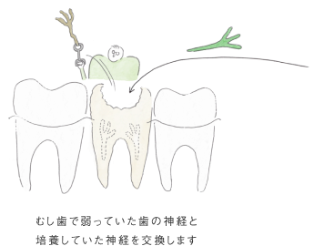 むし歯で弱っていた歯の神経と培養していた神経を交換します