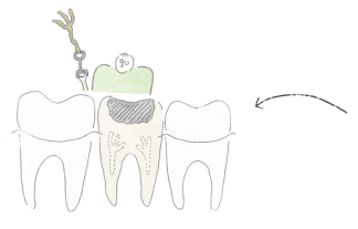 痛みが激しくなり、神経を抜き取ります