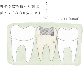 神経を抜き取った歯は歯としての力を失います